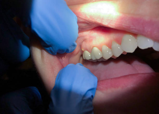 Best Lost Filling or Crown Replacement in North Barrington, IL